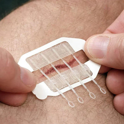 Wound Closure Kit – 2 Pcs, Suture-Free Strips