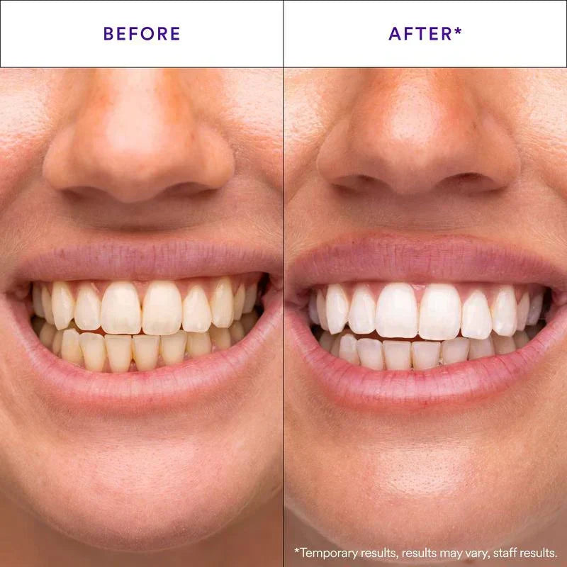 Teeth Whitening Strips