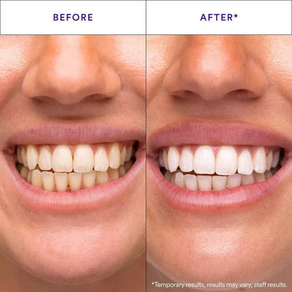 Teeth Whitening Strips